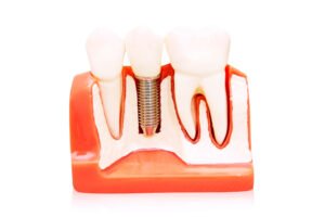 close up image of El Dorado Hills dental implants