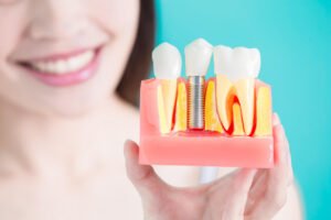 A dentist discusses Dental implants in Placerville CA