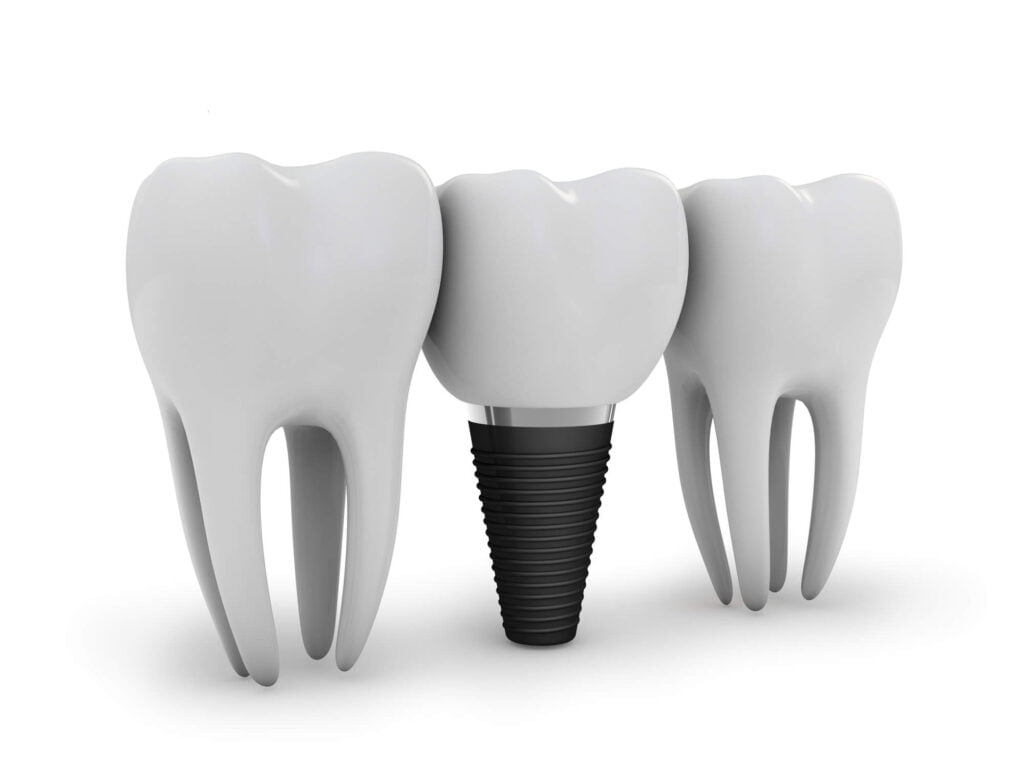 a closer look at Dental implants in Placerville CA