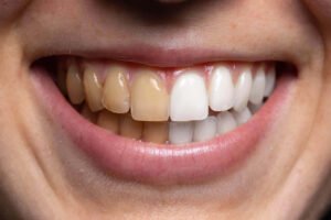 before and after view of Cameron Park Cosmetic Dentistry teeth whitening services