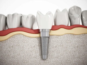 a closer view of Dental Implants in Cameron Park