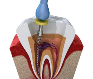 family dentist in Placerville, CA, shows an image of root canal treatment